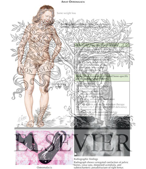 Watermarked preview of labeled image: Childhood Rickets, Adult Osteomalacia