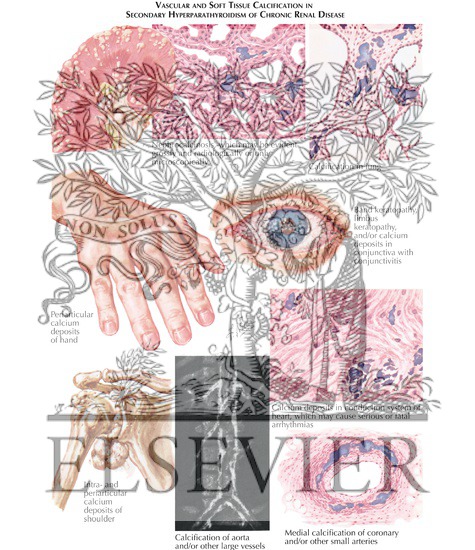 Watermarked preview of labeled image: Tissue Calcification