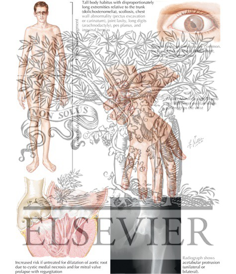 Watermarked preview of labeled image: Characteristics of Marfan Syndrome