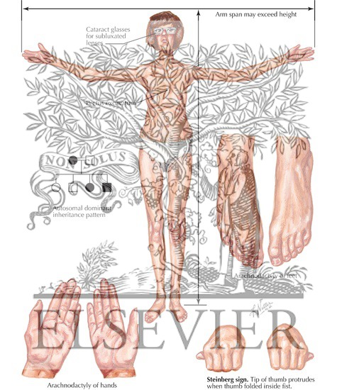 Watermarked preview of labeled image: Marfan Syndrome
