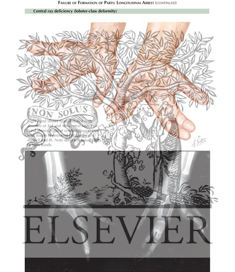 Watermarked preview of labeled image: Failure of Formation of Parts: Longitudinal Arrest (Central deficiency lobster-claw deformity)