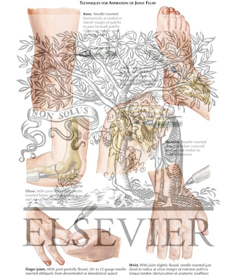 Watermarked preview of labeled image: Techniques for Aspiration of Joint Fluid