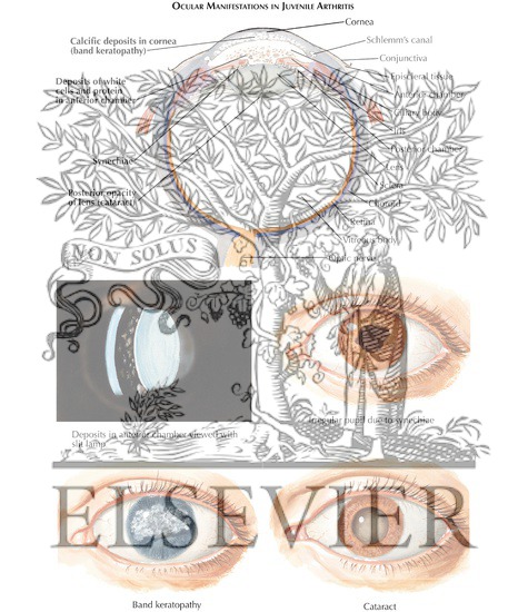 Watermarked preview of labeled image: Chronic Iridocyclitis of Juvenile Rheumatoid Arthritis (JRA) Particularly Found In Monarticular Onset
