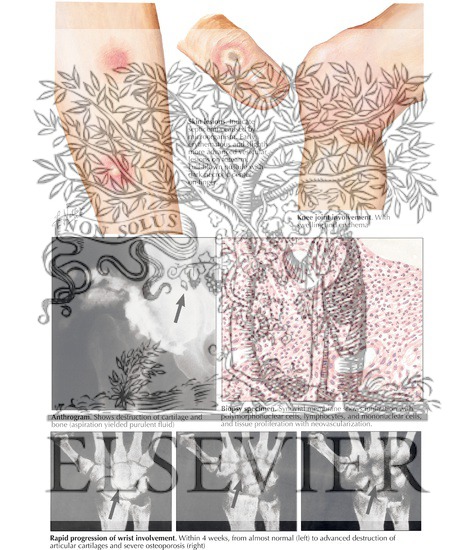 Watermarked preview of labeled image: Infectious Arthritis