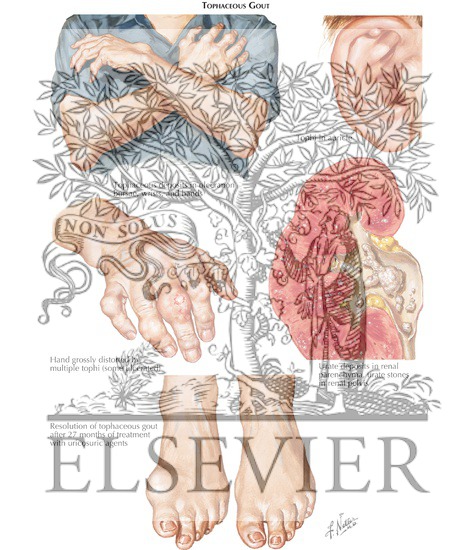 Watermarked preview of labeled image: Tophaceous Gout
Gouty Arthritis