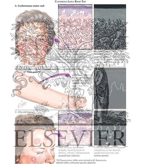 Cutaneous Lupus Band Test