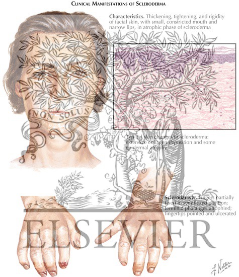 Scleroderma (Progressive Systemic Sclerosis)