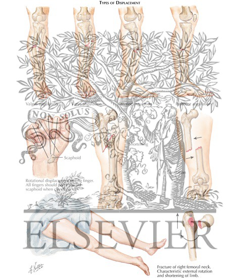 Watermarked preview of labeled image: Types of Displacement