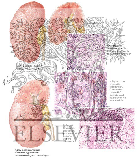 The Kidneys in Hypertension: Benign and Malignant