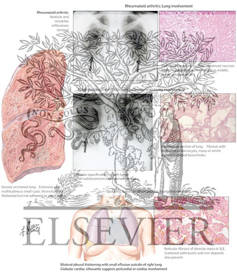 Watermarked preview of labeled image: Collagen-Vascular Disease: Lung Involvement