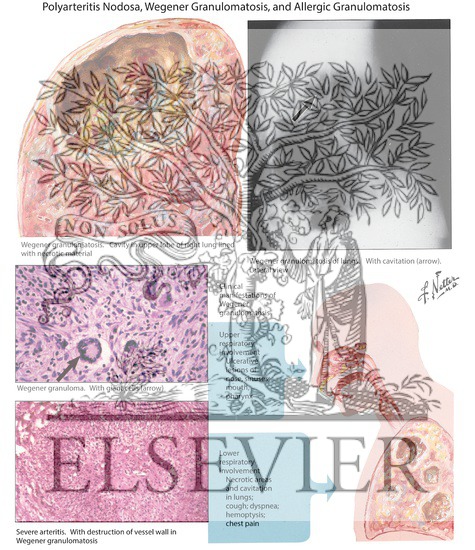 Watermarked preview of labeled image: Systemic Vasculitis: Wegener Disease