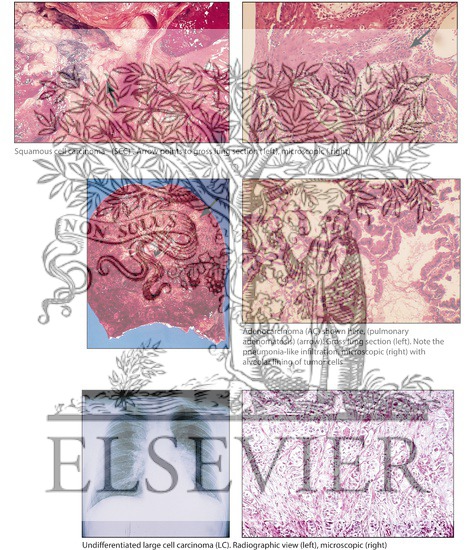 Watermarked preview of labeled image: Non-Small-Cell Lung Cancer