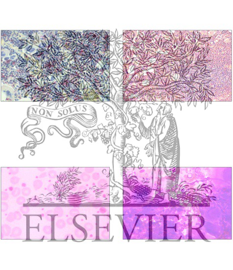 Watermarked preview of unlabeled image: Primary Thrombocythemia