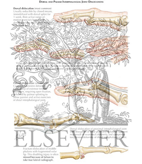 Watermarked preview of labeled image: Dorsal and Palmar Interphalangeal Joint Dislocations