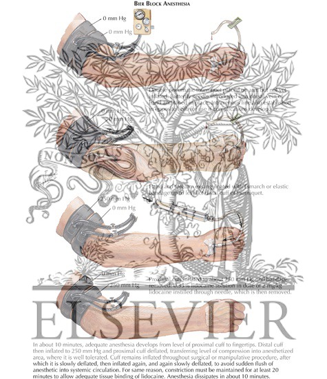 Watermarked preview of labeled image: Bier Block Anesthesia