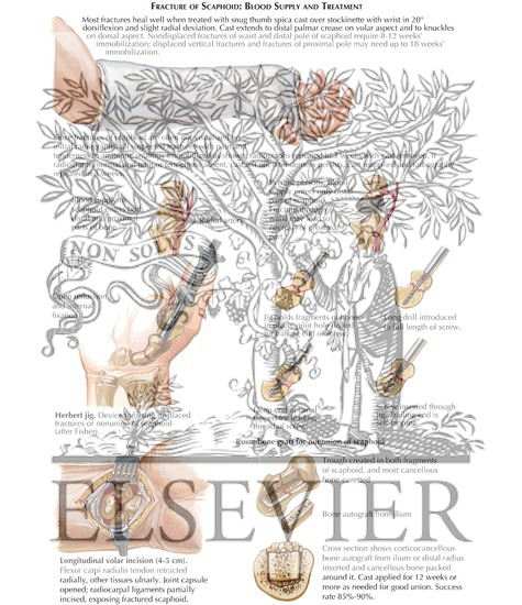 Watermarked preview of labeled image: Fracture of Scaphoid: Blood Supply and Treatment