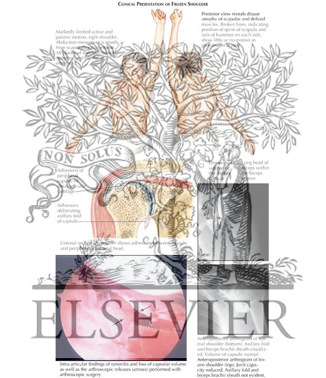 Adhesive capsulitis exercises pdf picture