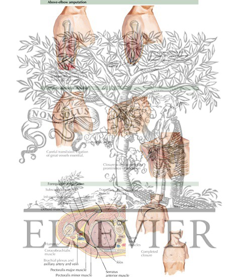 Watermarked preview of labeled image: Amputation of Upper Arm and Shoulder