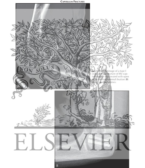 Watermarked preview of labeled image: Capitellum Fractures