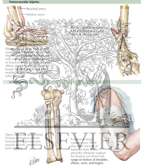 Watermarked preview of labeled image: Complications of Fracture