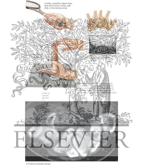 Watermarked preview of labeled image: Fracture of Hamulus of Hamate