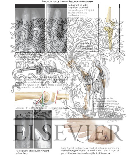 Watermarked preview of labeled image: Modular Versus Implant Resection Arthroplasty