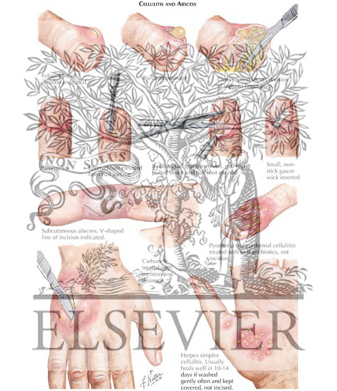 Watermarked preview of labeled image: Cellulitis and Epidermal Abscess