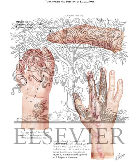 Watermarked preview of labeled image: Tenosynovitis and Infection of Fascial Space