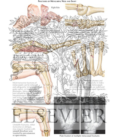 Fractures of Metacarpal Neck and Shaft