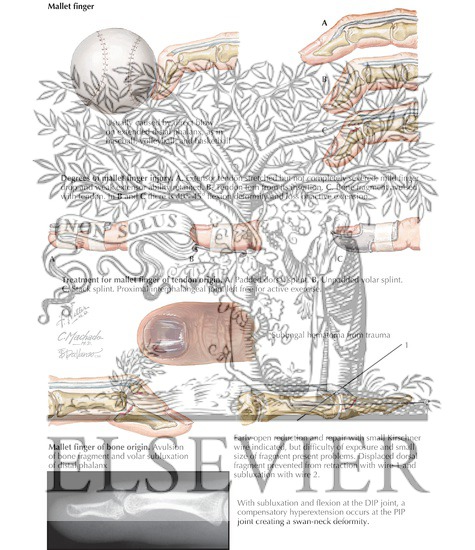 Watermarked preview of labeled image: Injuries to the Fingertip