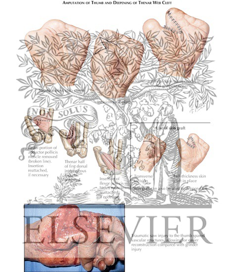Amputation of Thumb and Deepening of Thenar Web Cleft