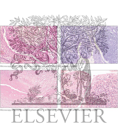 COLLAGEN VASCULAR DISEASE collagen vascular disease: