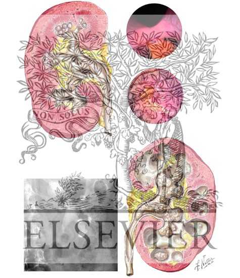 Treatment guidelines for kidney stones picture