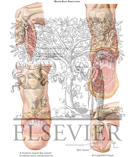 Below-Knee Amputation
