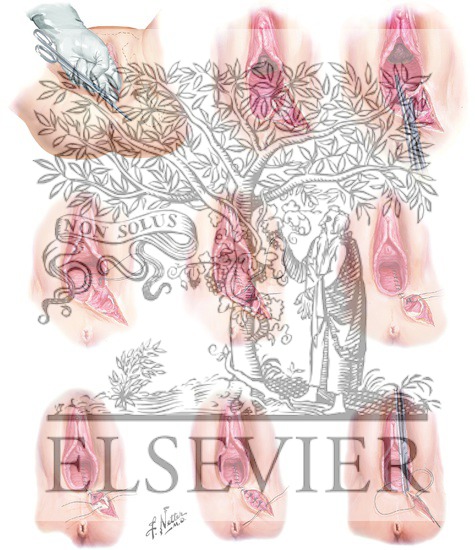 Watermarked preview of unlabeled image: Episiotomy