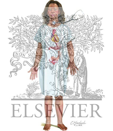 Watermarked preview of unlabeled image: Hyperthyroidism with Diffuse Goiter (Graves' Disease)