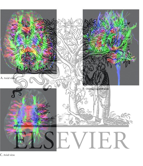 Watermarked preview of unlabeled image: Color Imaging of the Corpus Callosum by Diffusion Tensor Imaging