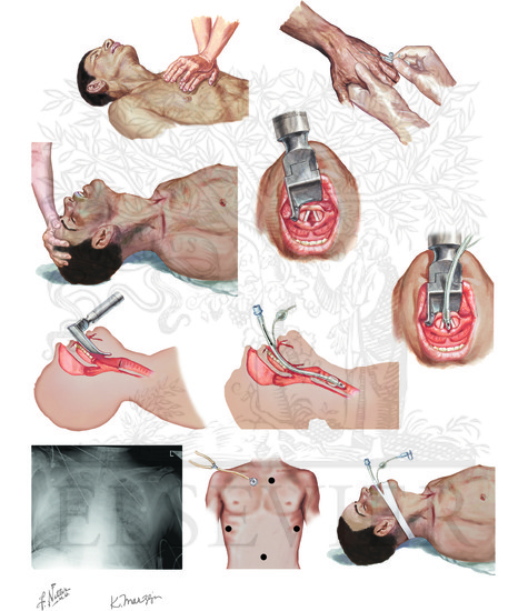 Endotracheal intubation: crash airway intubation for cardiorespiratory arrest