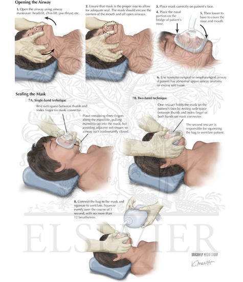 Bag Valve Mask Ventilation