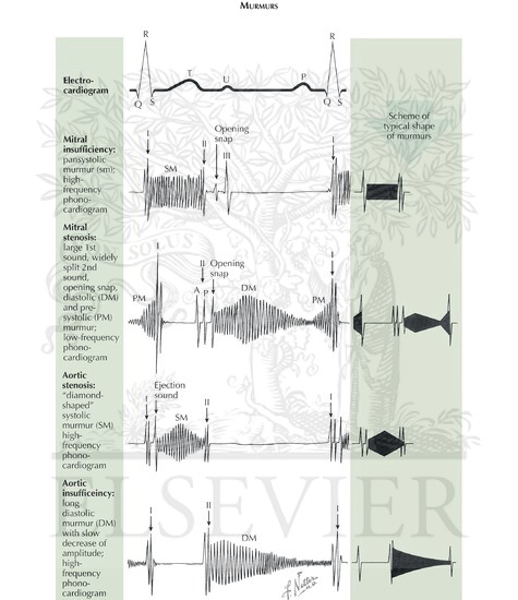 Cardiovascular Examination: Murmurs