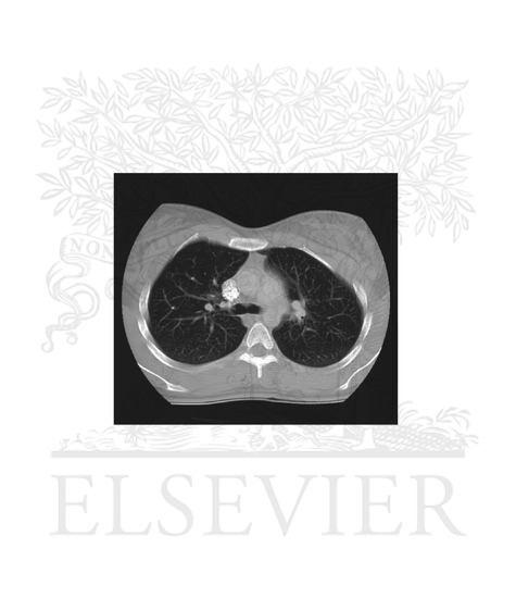 Watermarked preview of unlabeled image: Imaging of mediastinum