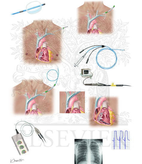 Transvenous pacemaker placement