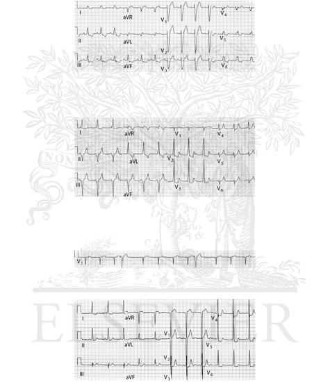 QRS complex