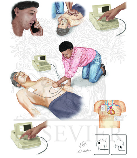 Watermarked preview of unlabeled image: Sudden cardiac arrest: steps preceding the activation of the automated external defibrillator