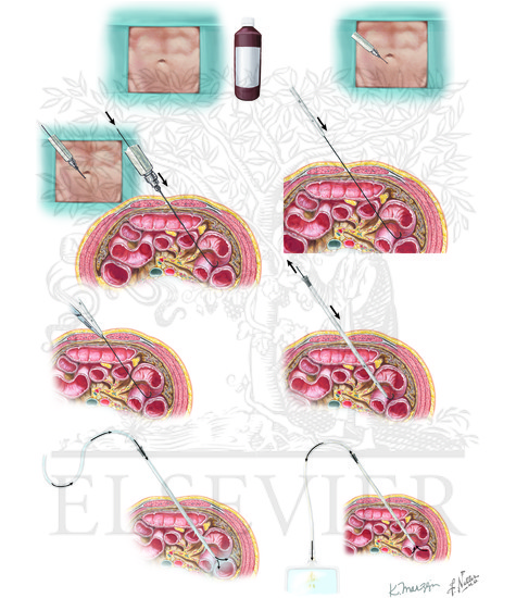 Diagnostic peritoneal lavage