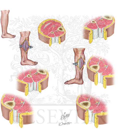 Leg Fasciotomy: Double Incision