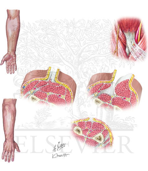 Forearm Fasciotomy