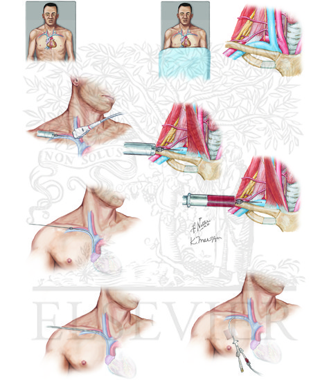 Watermarked preview of unlabeled image: Subclavian vein catheterization