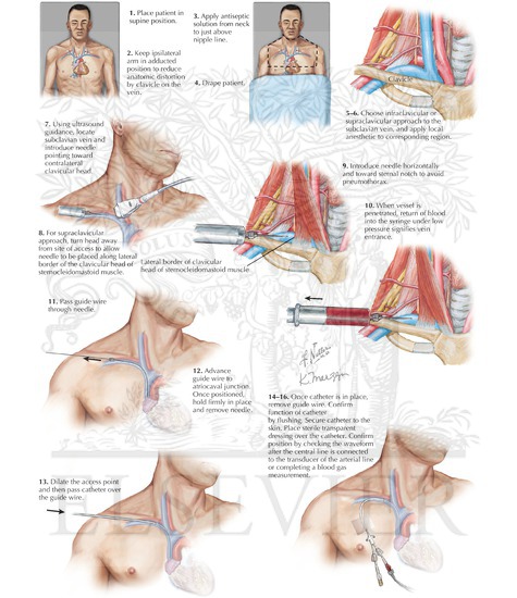 Subclavian vein catheterization