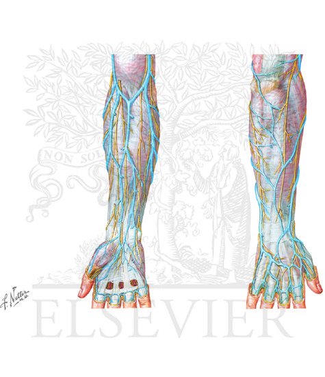 Veins of the hand and forearm. The median cubital vein is not seen in the figure and can often be a normal anatomic variant
